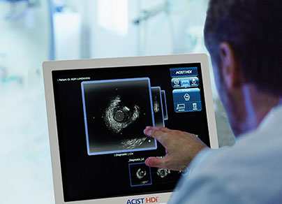 Intravascular Ultrasound Guided PCI | HDi HD IVUS & Catheter