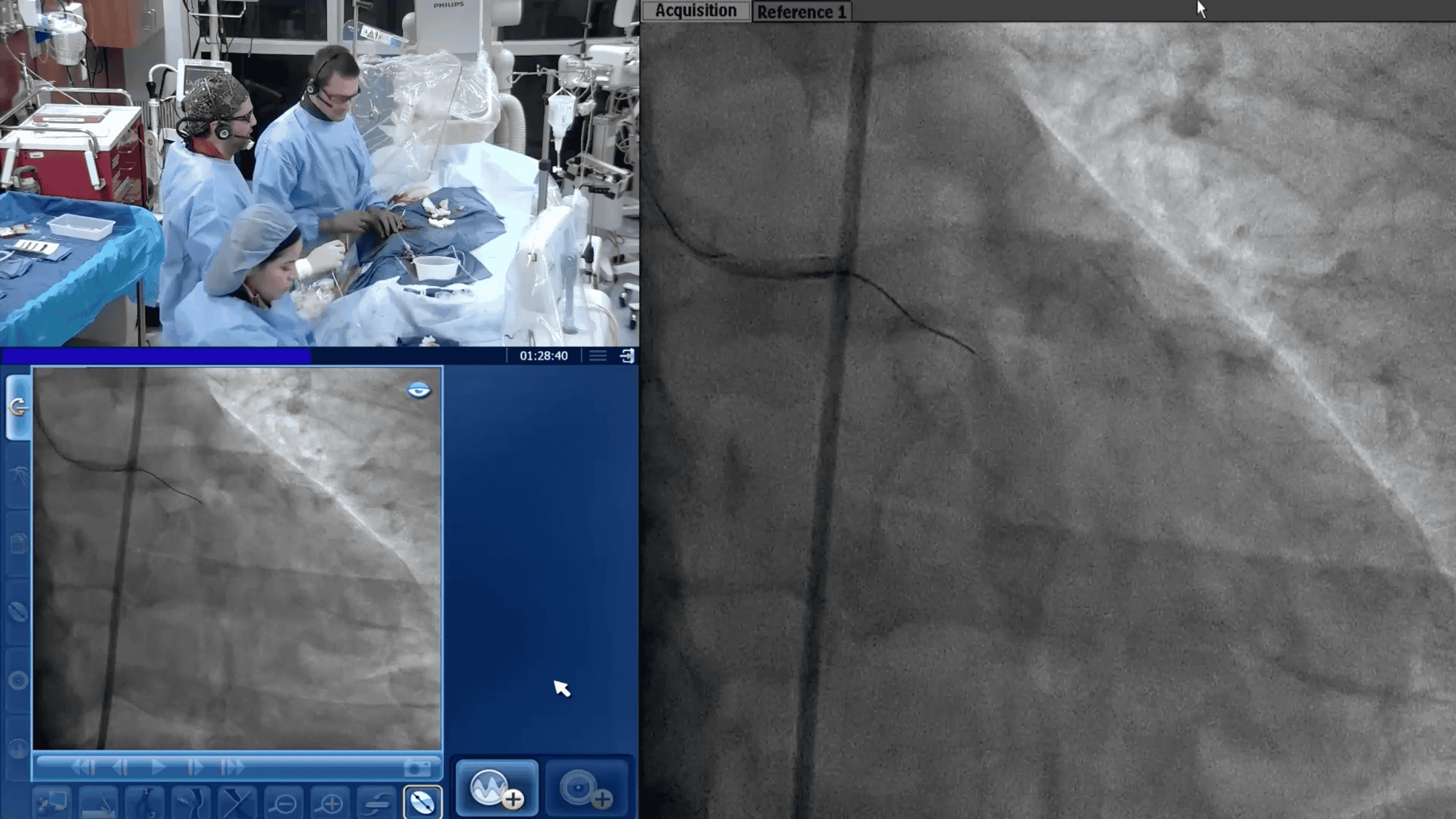 Screenshot from Final Angiogram video