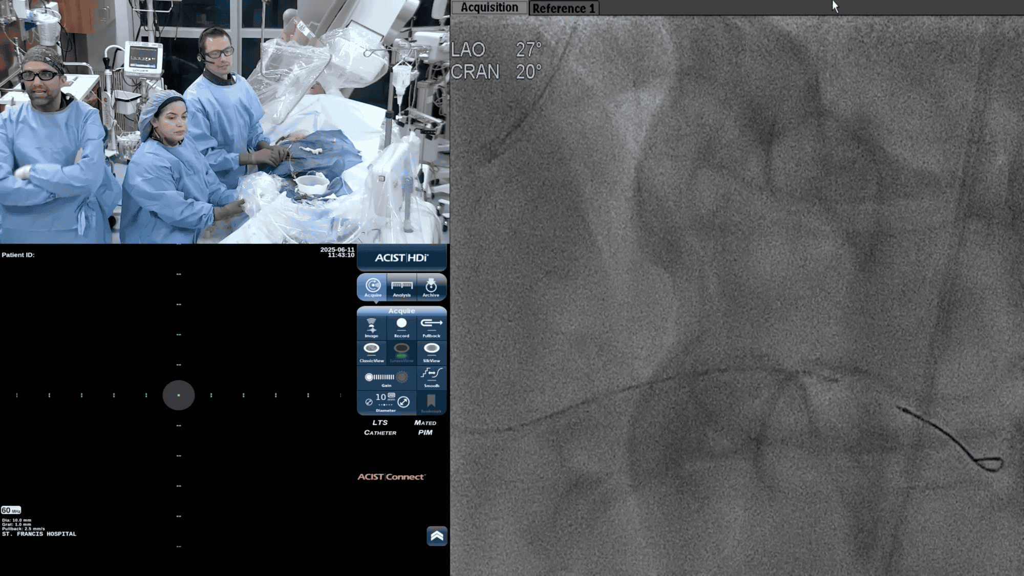 Screenshot from Final IVUS (PLA)-Fully Optimized Stent Using 3mL of Contrast video