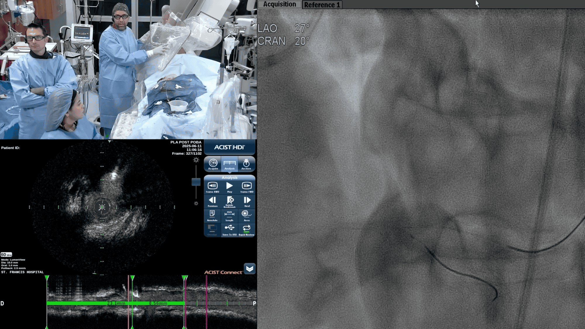 Screenshot from IVUS Post DES-PLA video