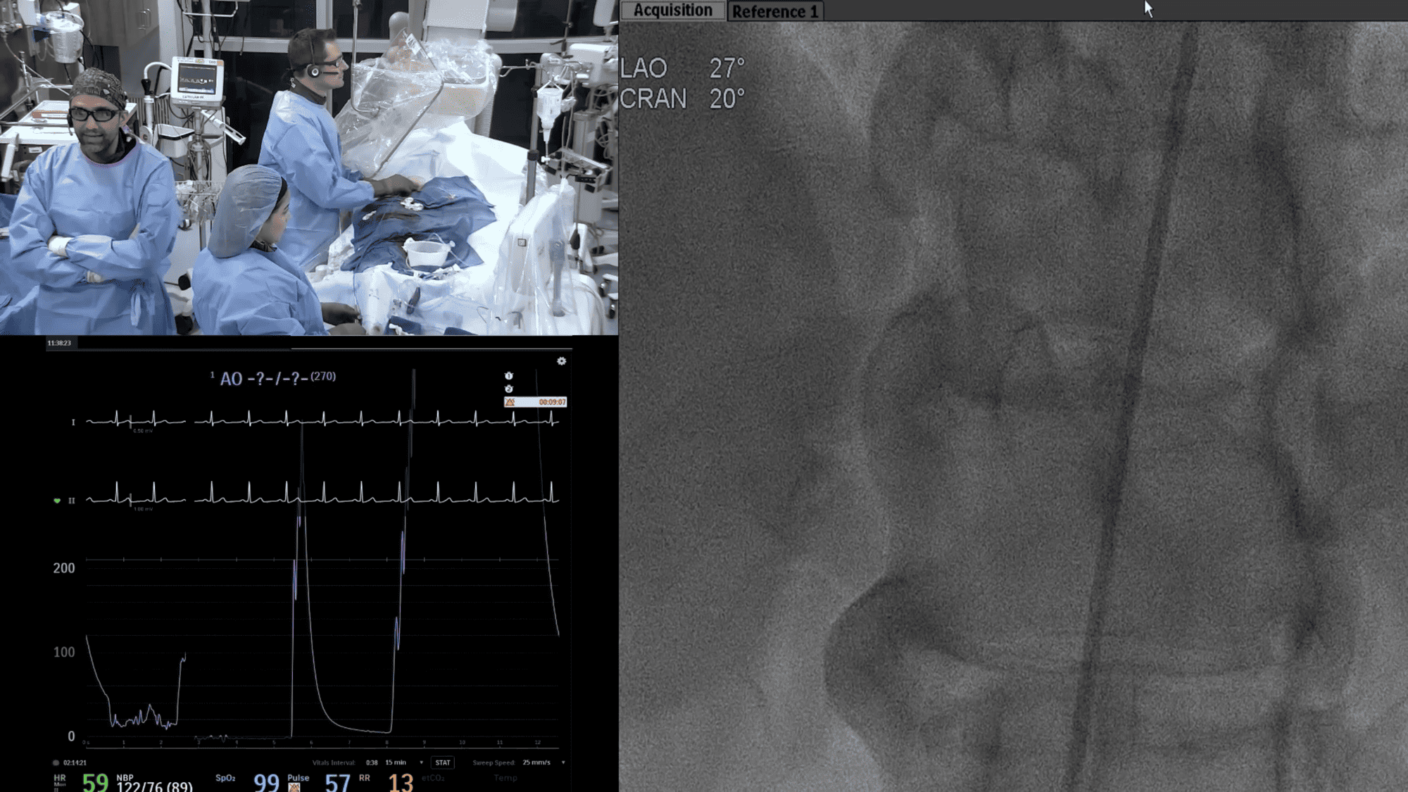 Screenshot from Left Side Prep-DCB Strategy Using Navvus video