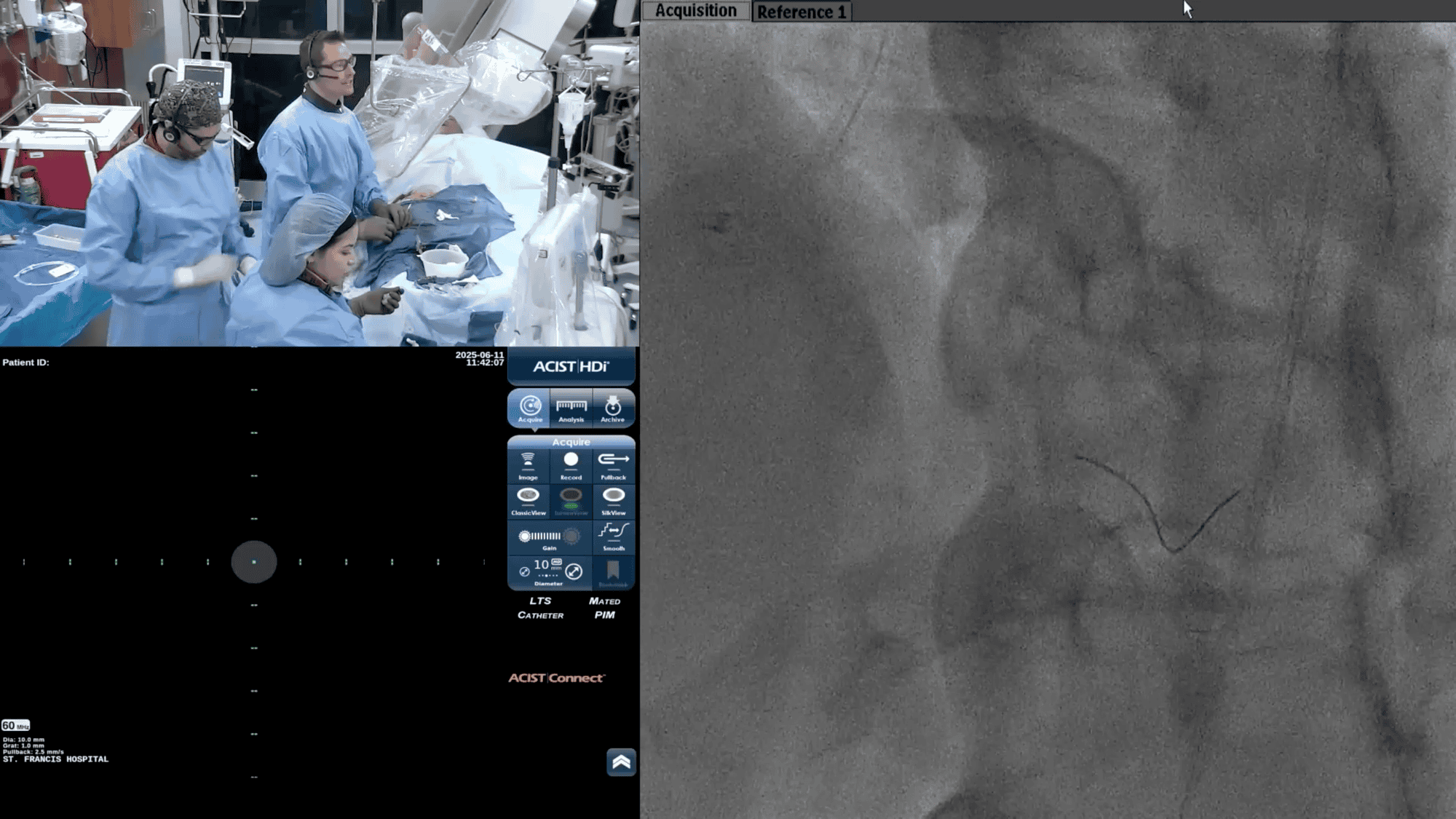 Screenshot from Limited Reasons for Additional Contrast After Procedure with IVUS + Physiology video