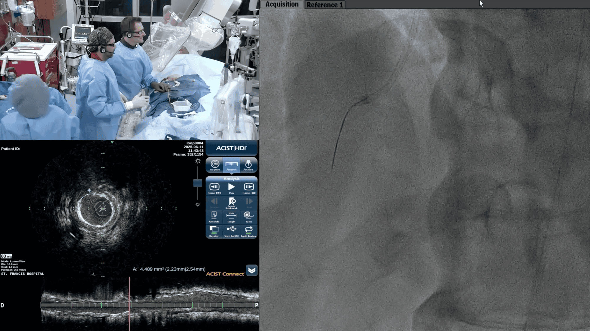 Screenshot from Post Angiogram (RCA) and Navvus’ Usefulness in Complex PCIs video