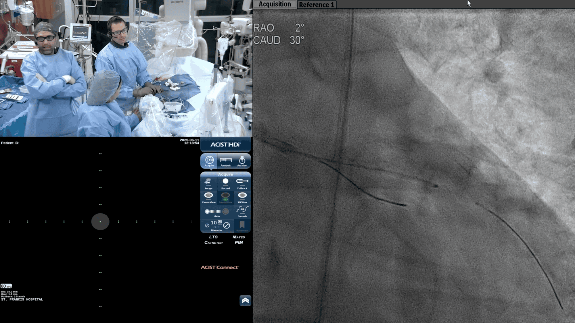 Screenshot from Post DCB IVUS video
