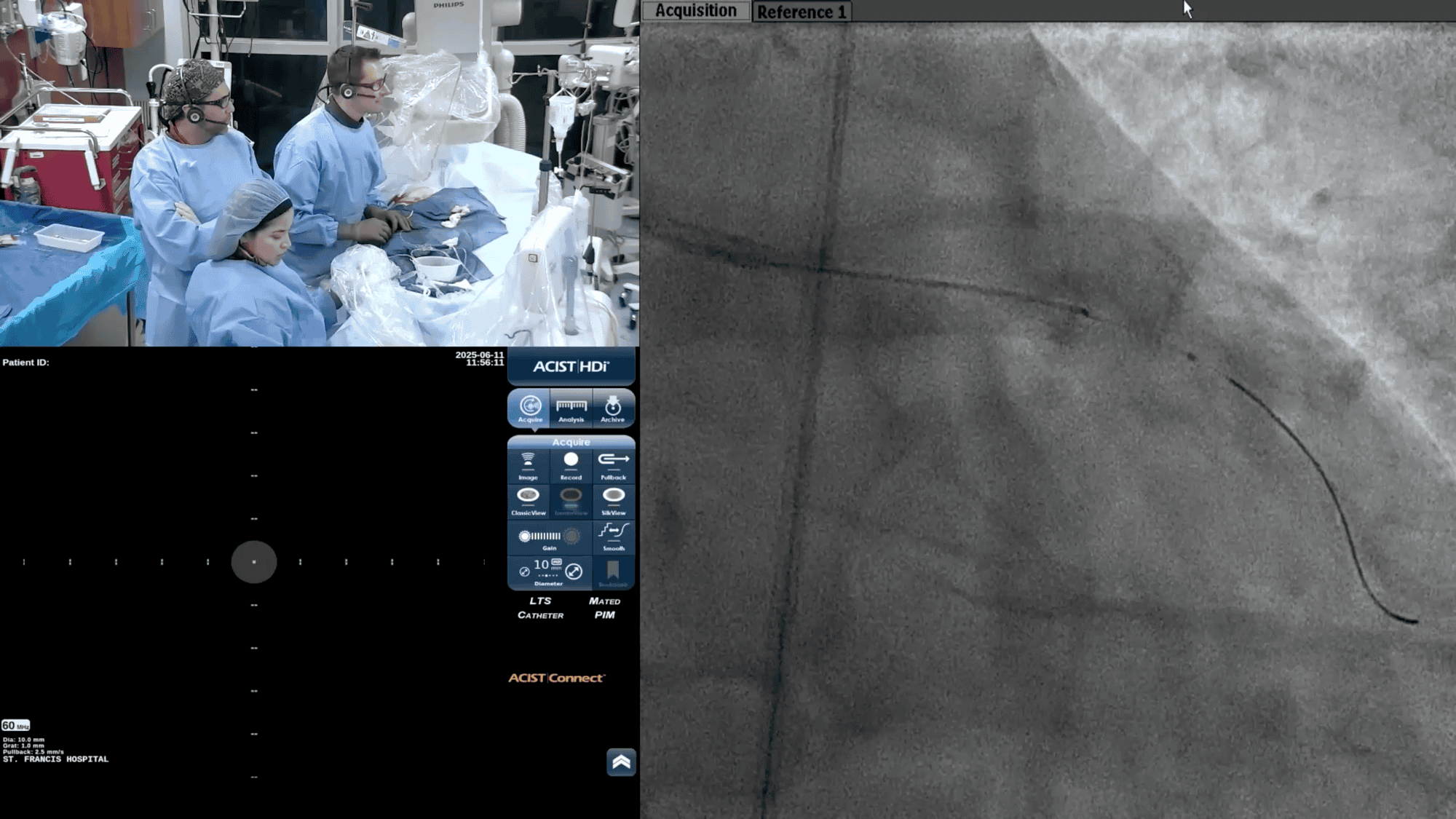 Screenshot from Pre-IVUS-Left Side Planning for DCB & Strategy to Determine Stent Success Post DCB video