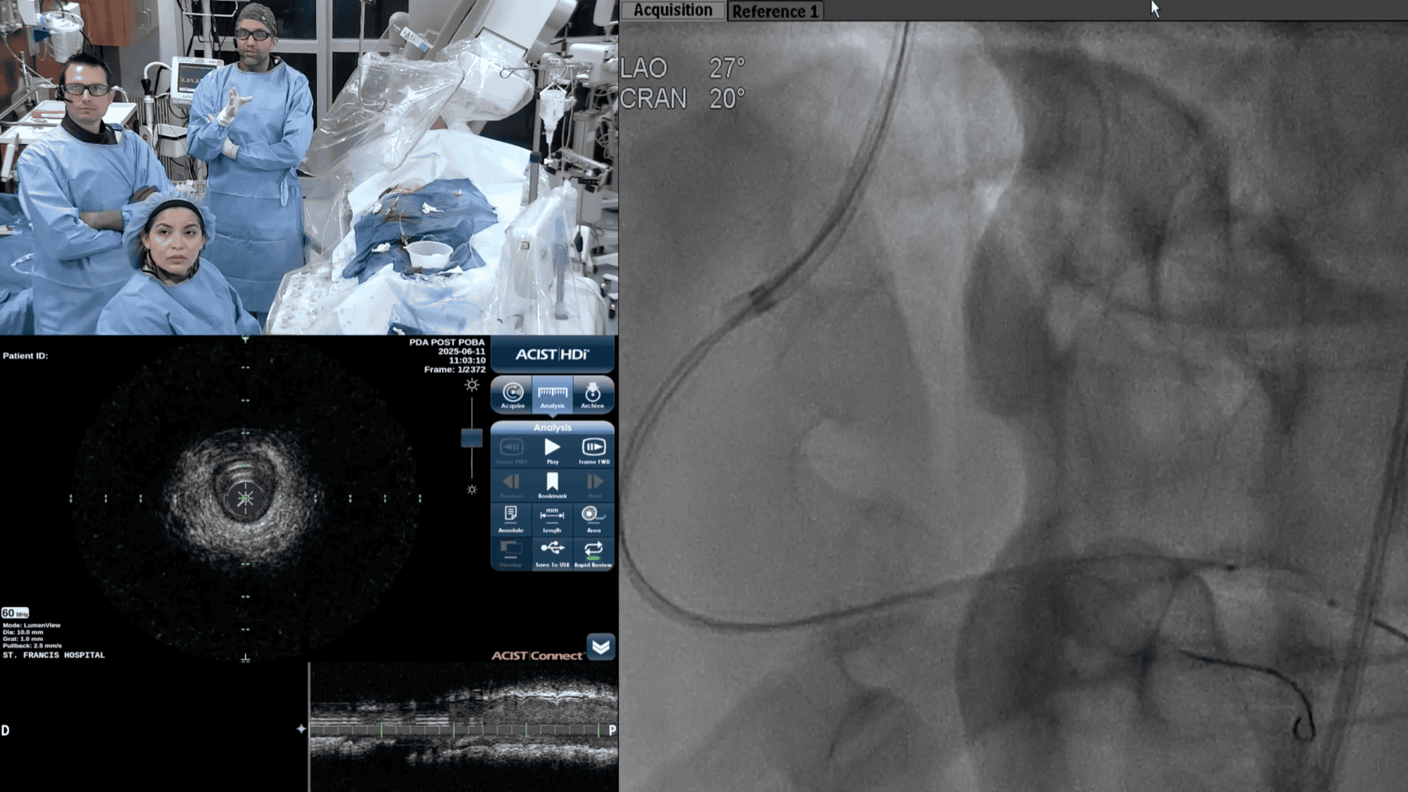 Screenshot from Pre-Procedural IVUS-PDA-PLA Post POBA video