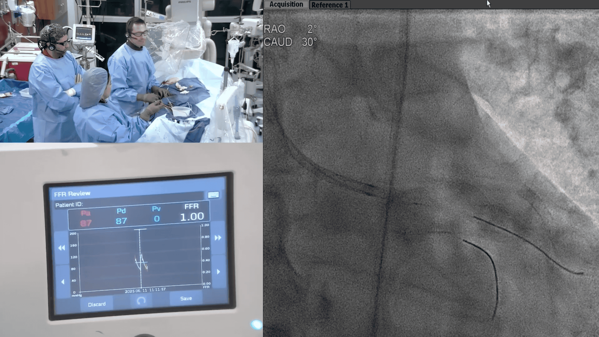 Screenshot from The Usefulness of Navvus for Arterial Physiological Assessment Before DCB video