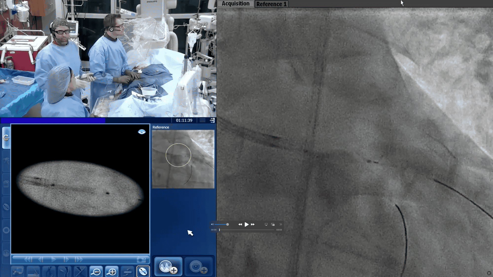 Acist Minimizing Contrast Volume in Angiography and PCI with ACIST Technology ...